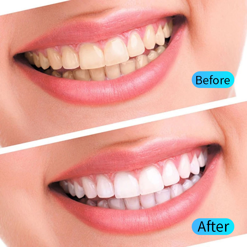 Teeth Whitening Gel Kit Oral H – Teeth Whitening Opalescence recenzja i cena