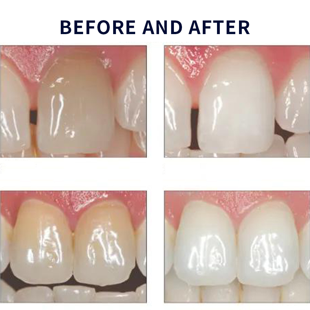 Opalescence Whitening 20% PF 2 – Teeth Whitening Singapore recenzja i cena
