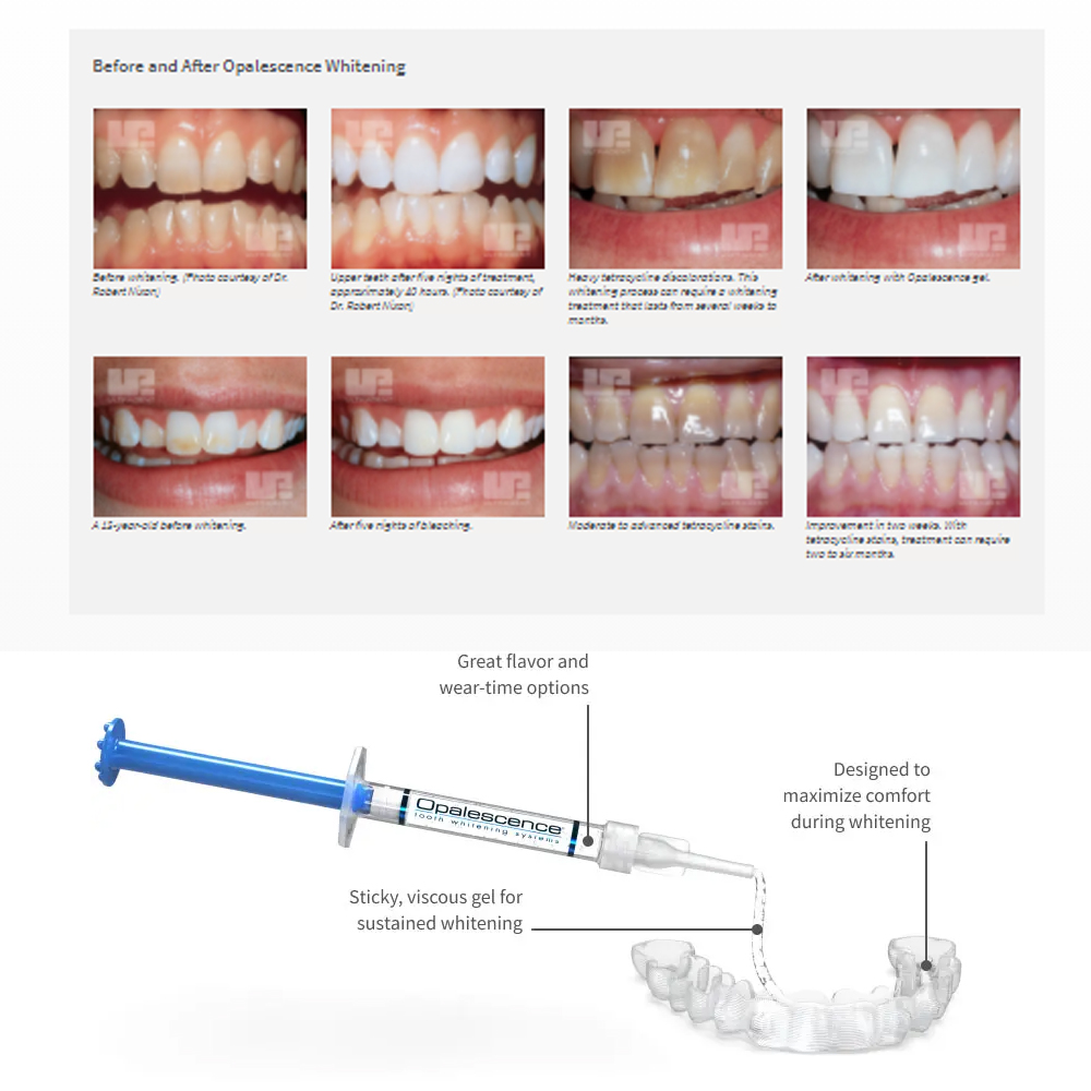 Opalescence Whitening 20% PF 2 – Teeth Whitening Singapore recenzja i cena