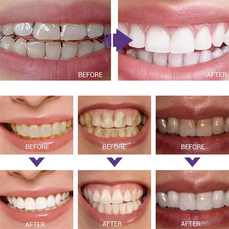 Teeth Cleansing Whitening Toot – Teeth Whitening Korea recenzja i cena