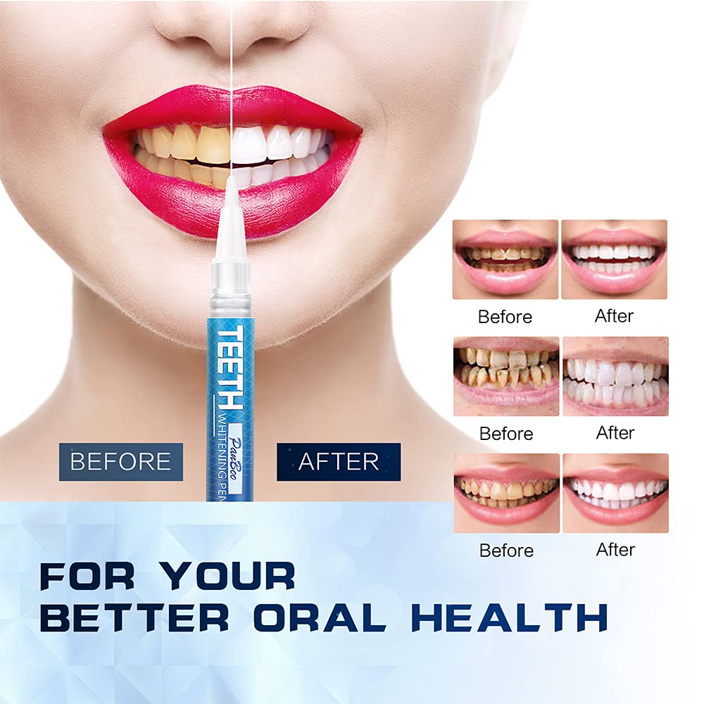 Teeth Whitening Pen Remove Cof – Teeth Whitening Opalescence recenzja i cena