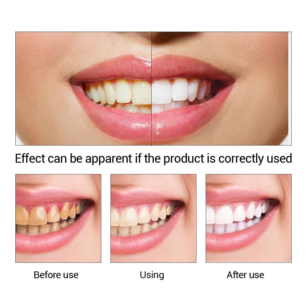 FTEENPLY Teeth Whitening Essen – Teeth Whitening/Bleaching recenzja i cena