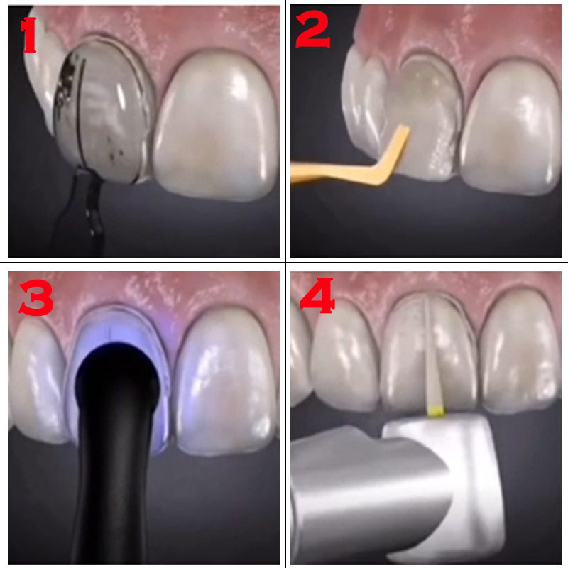 Dental Mould For Composite Res – Teeth Whitening Moulds recenzja i cena