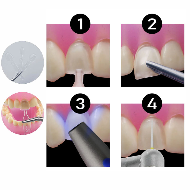 32pcs/Set Composite Resin Mold – Teeth Whitening Moulds recenzja i cena