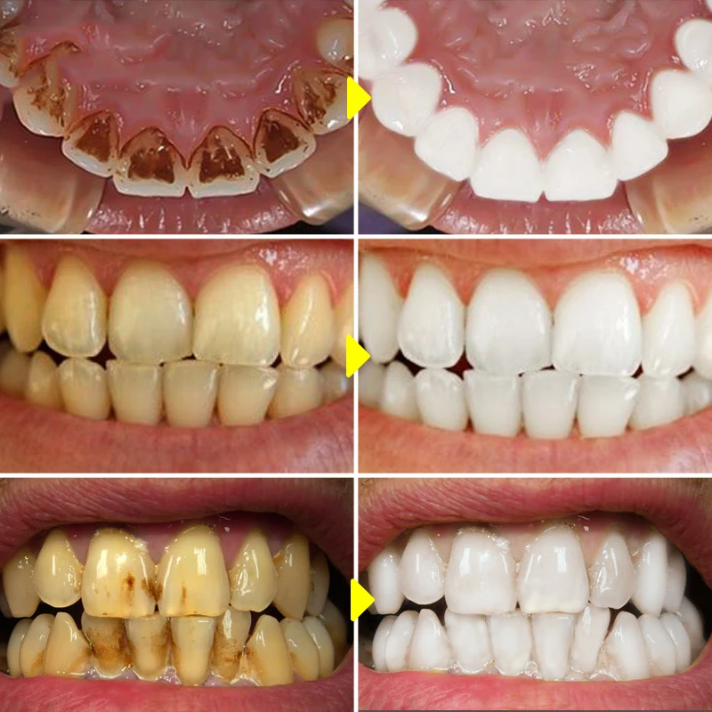 V34 Teeth Whitening Mousse Too – Teeth Whitening/Bleaching recenzja i cena