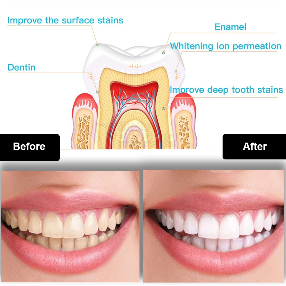 Dental Teeth Whitening Kit Min – Teeth Whitening Singapore recenzja i cena