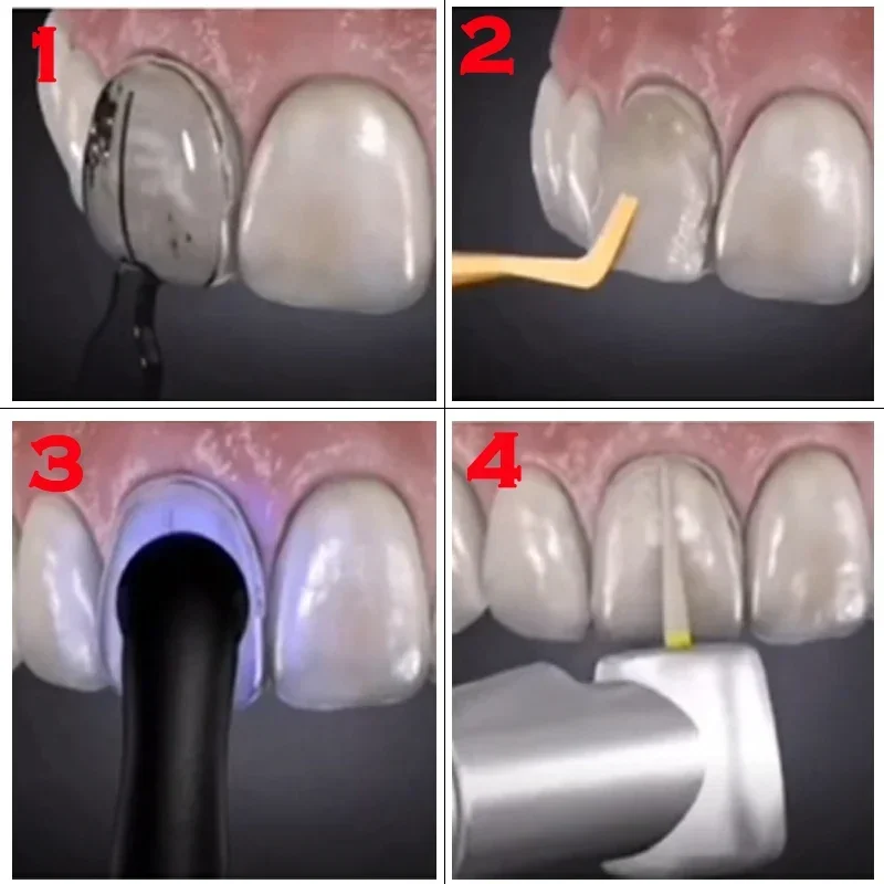 Dental Mould For Composite Res – Teeth Whitening Moulds recenzja i cena