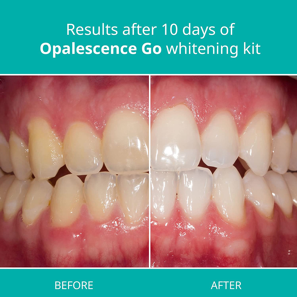 Opalescence Go Teeth Whitening – Teeth Whitening Opalescence recenzja i cena
