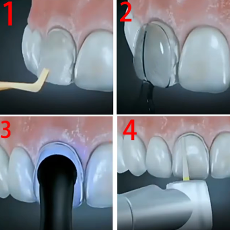 32Pcs/Box Dental Veneer Mould  – Teeth Whitening Moulds recenzja i cena